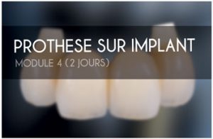 Prothese_sur_implant_2